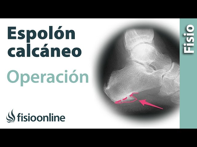 tiempo de recuperación de operación de espolón calcáneo