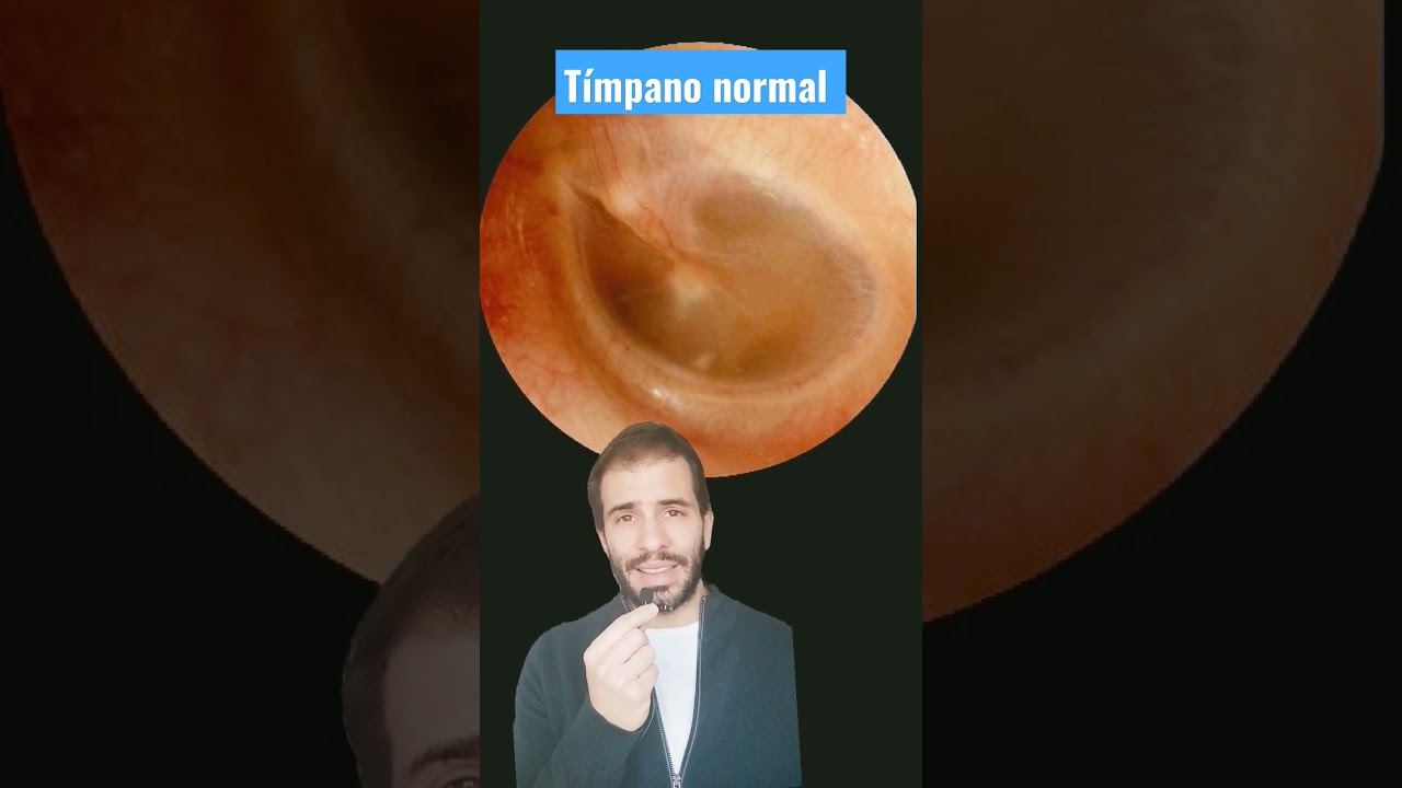 tiempo estimado de baja por una timpanoplastia