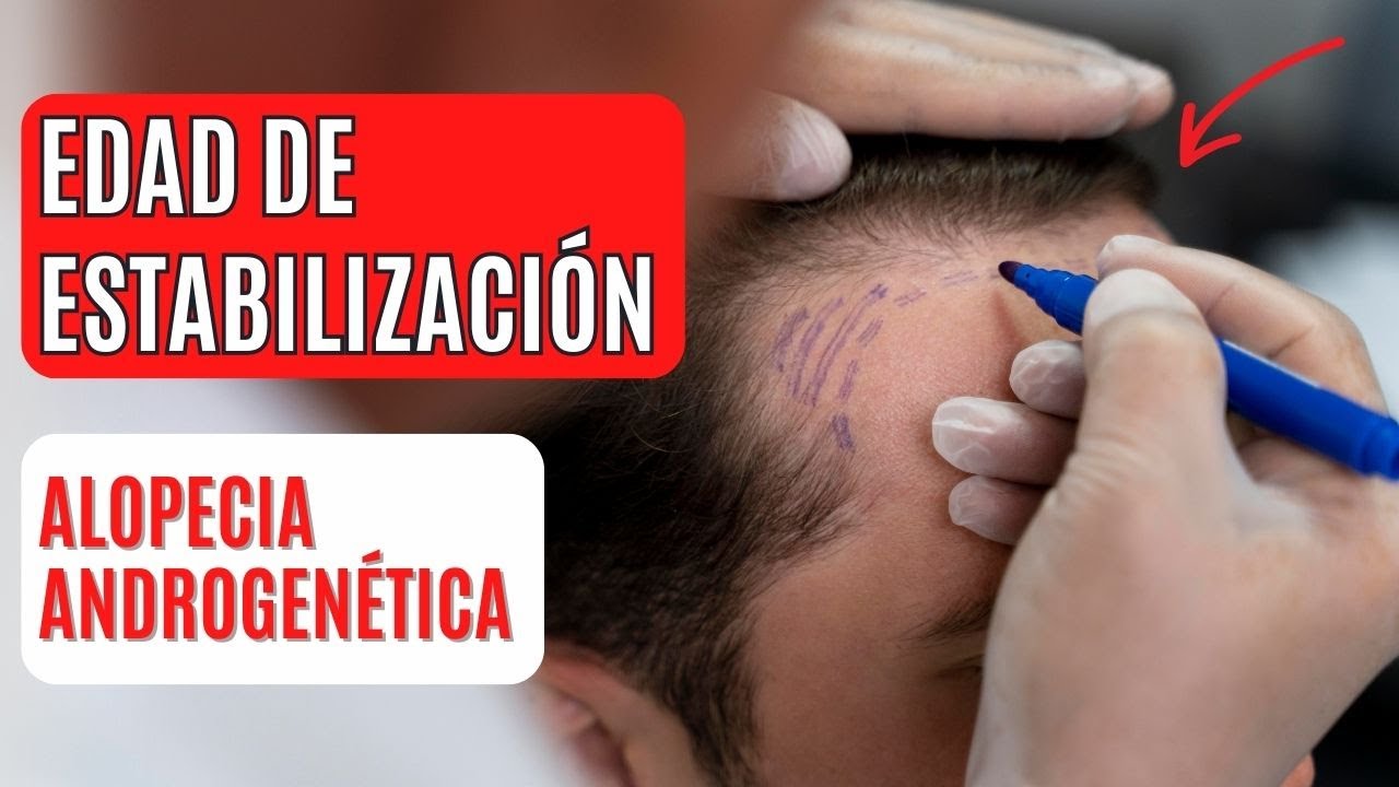 a que edad se estabiliza la alopecia androgenética en mujeres