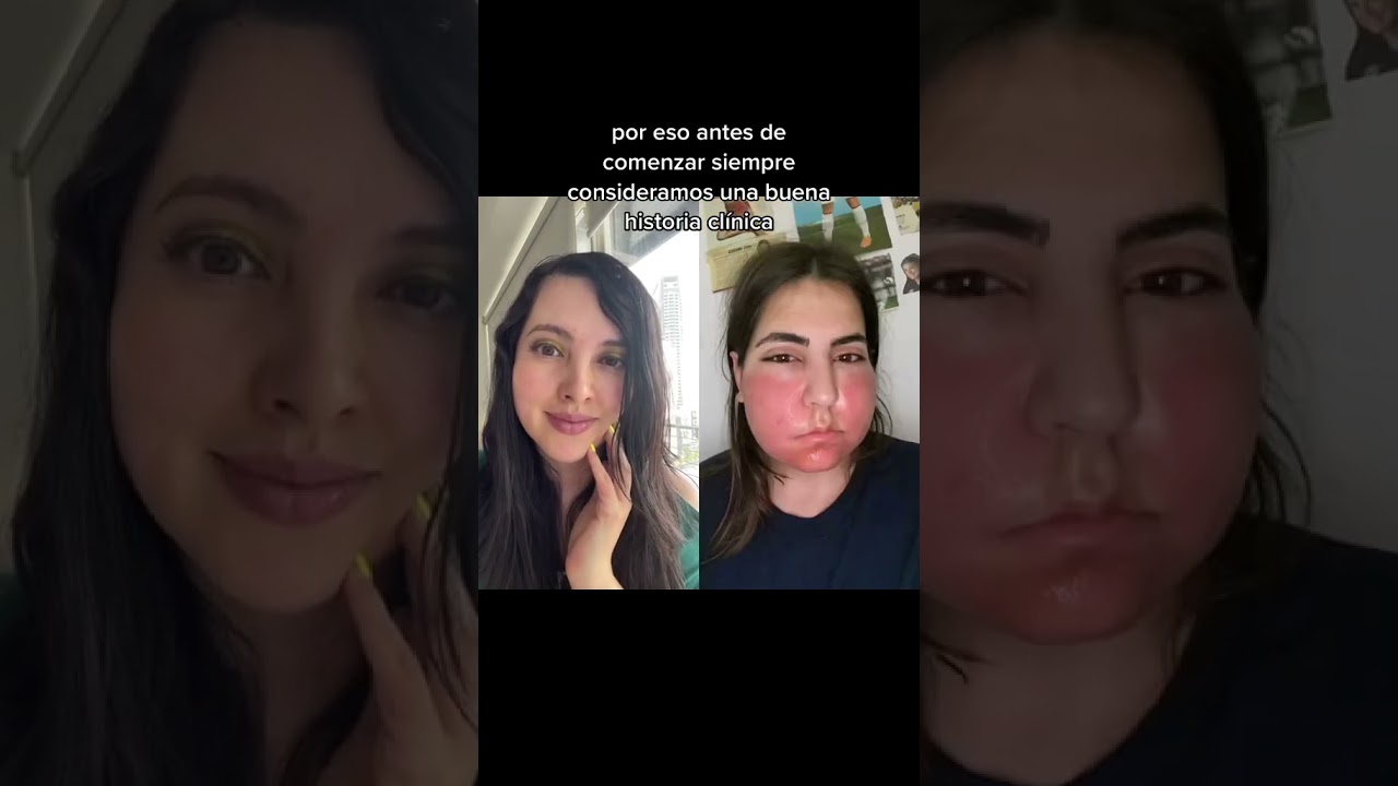 alergia al pino en la piel
