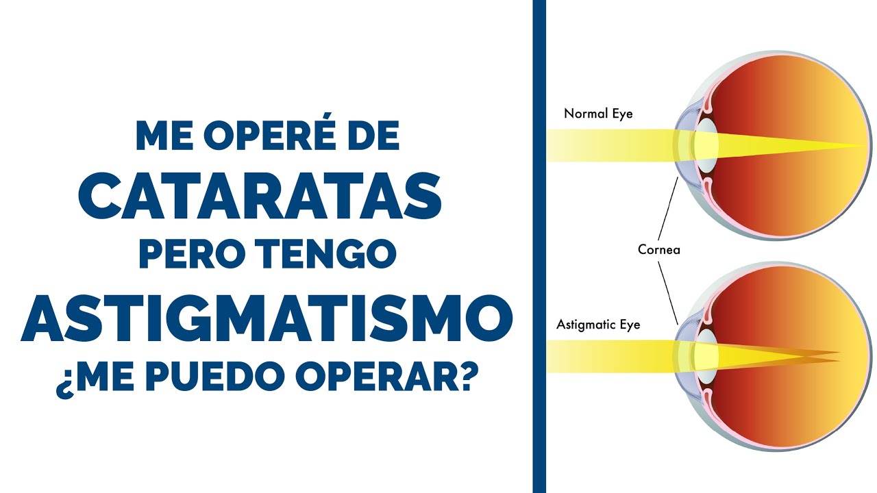 astigmatismo después de operación de cataratas