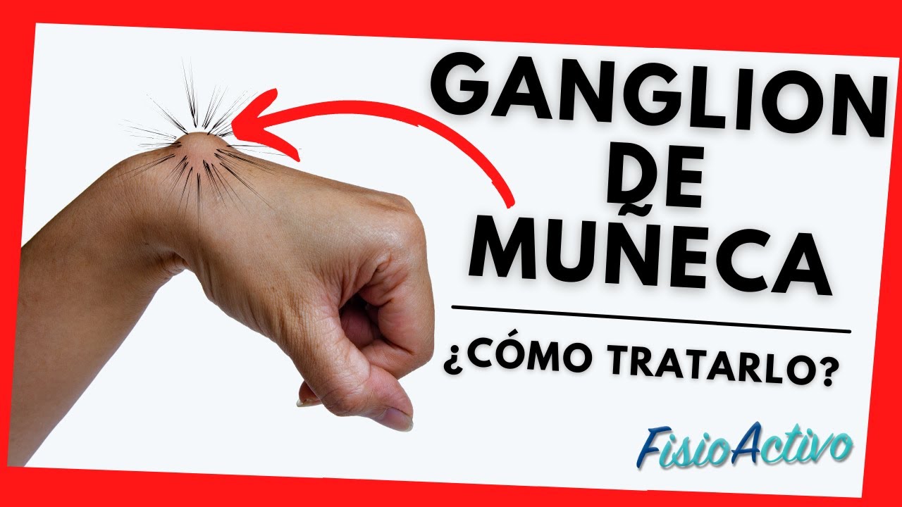 bola en la muñeca sin dolor