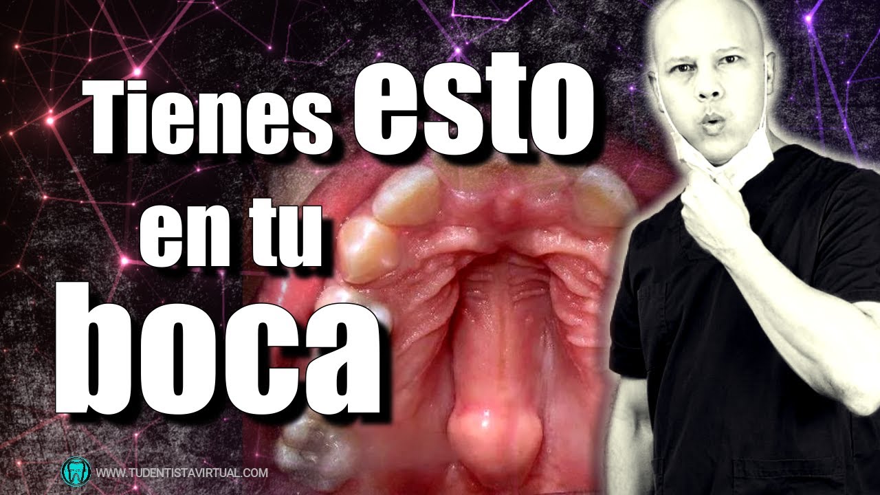 bolita dura en el paladar superior