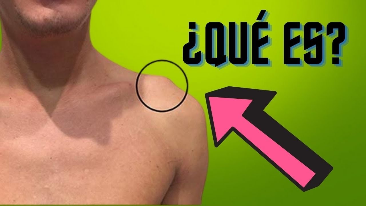 bulto en el hombro sin dolor
