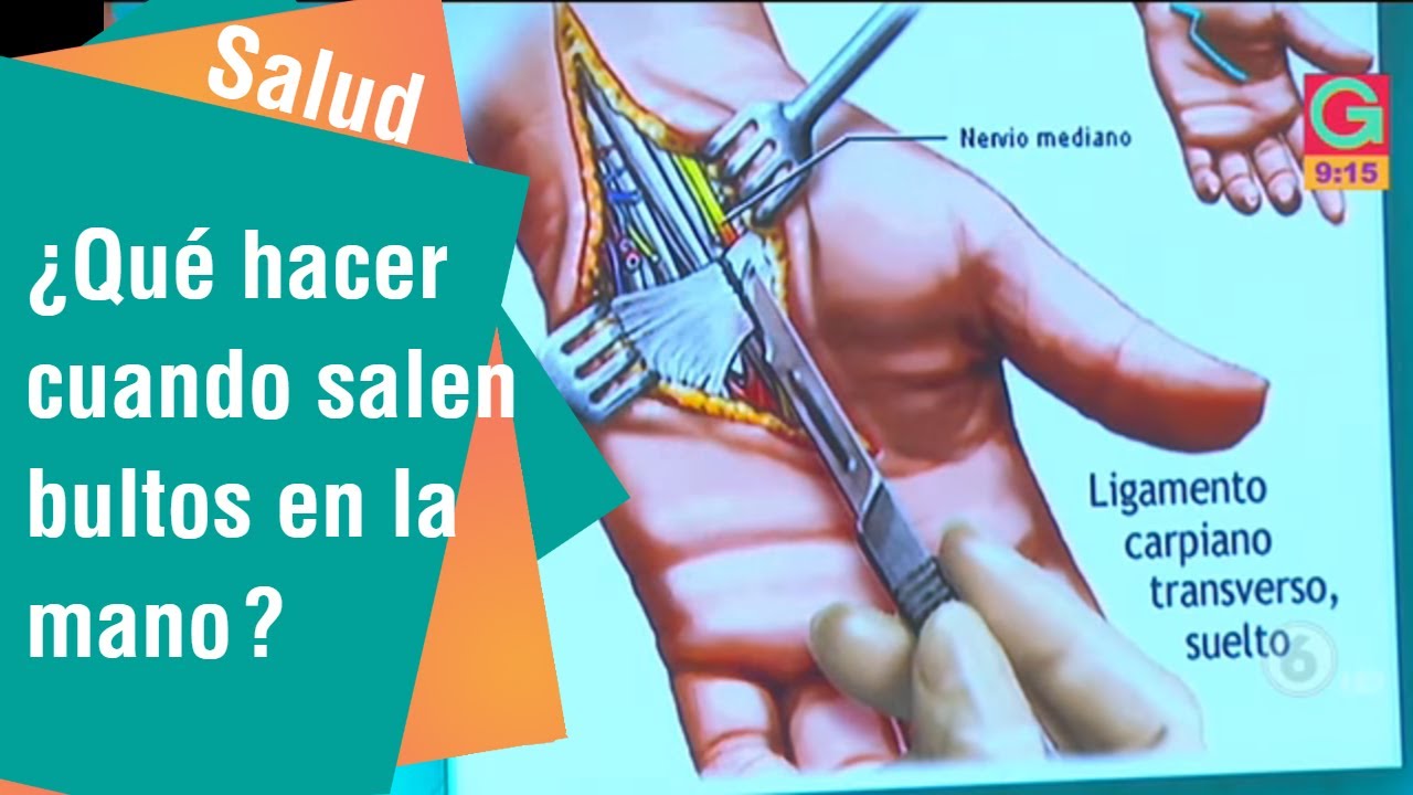 bultos en los tendones de la palma de la mano