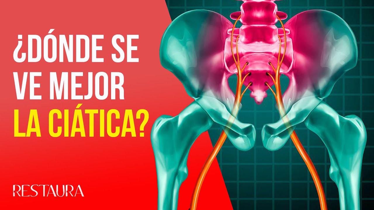 como se ve la ciática en una radiografía