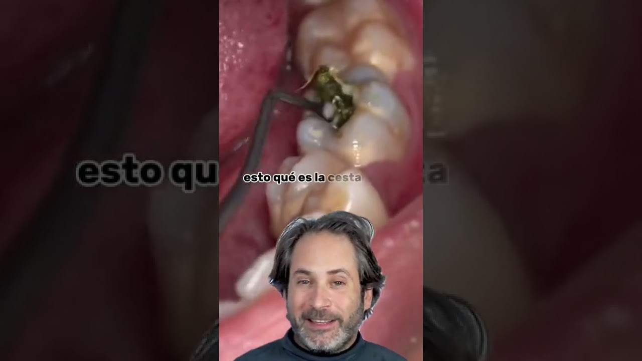 cuando empieza a doler una caries