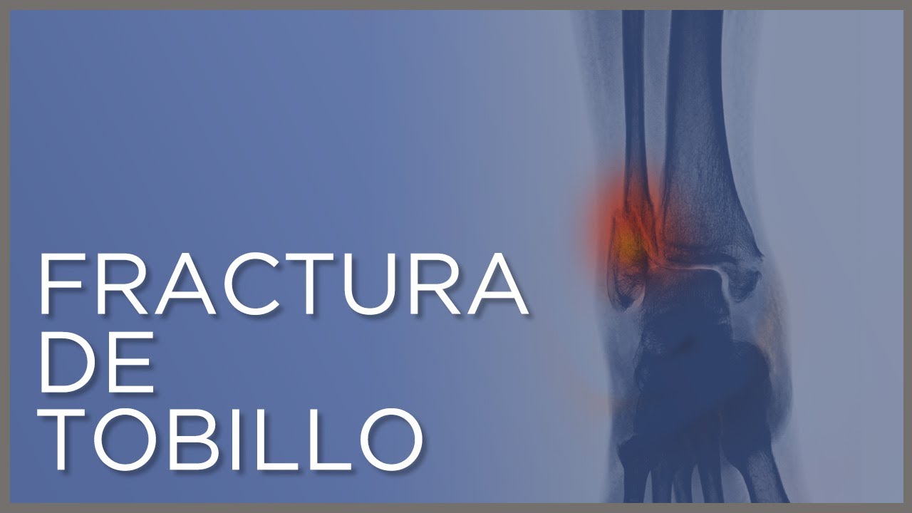 cuanto tiempo de rehabilitación necesita una fractura de tobillo