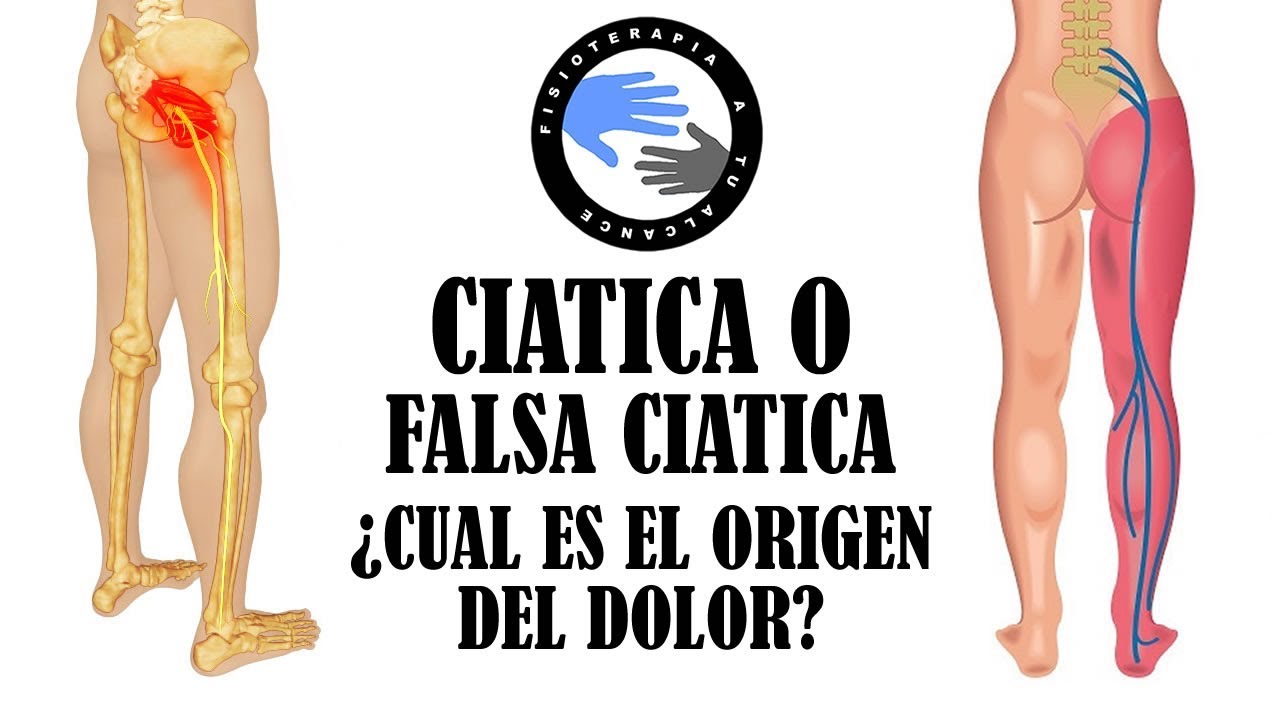 diferencia entre ciatica y sindrome piramidal