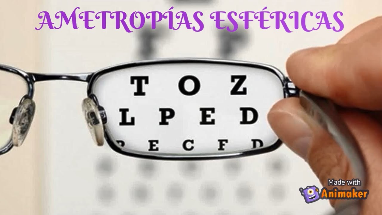 en qué ametropia la córnea no es esférica
