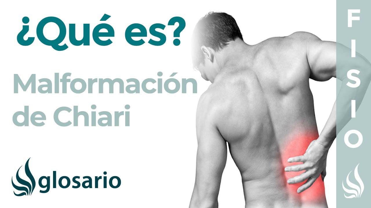 incapacidad laboral por síndrome de arnold chiari