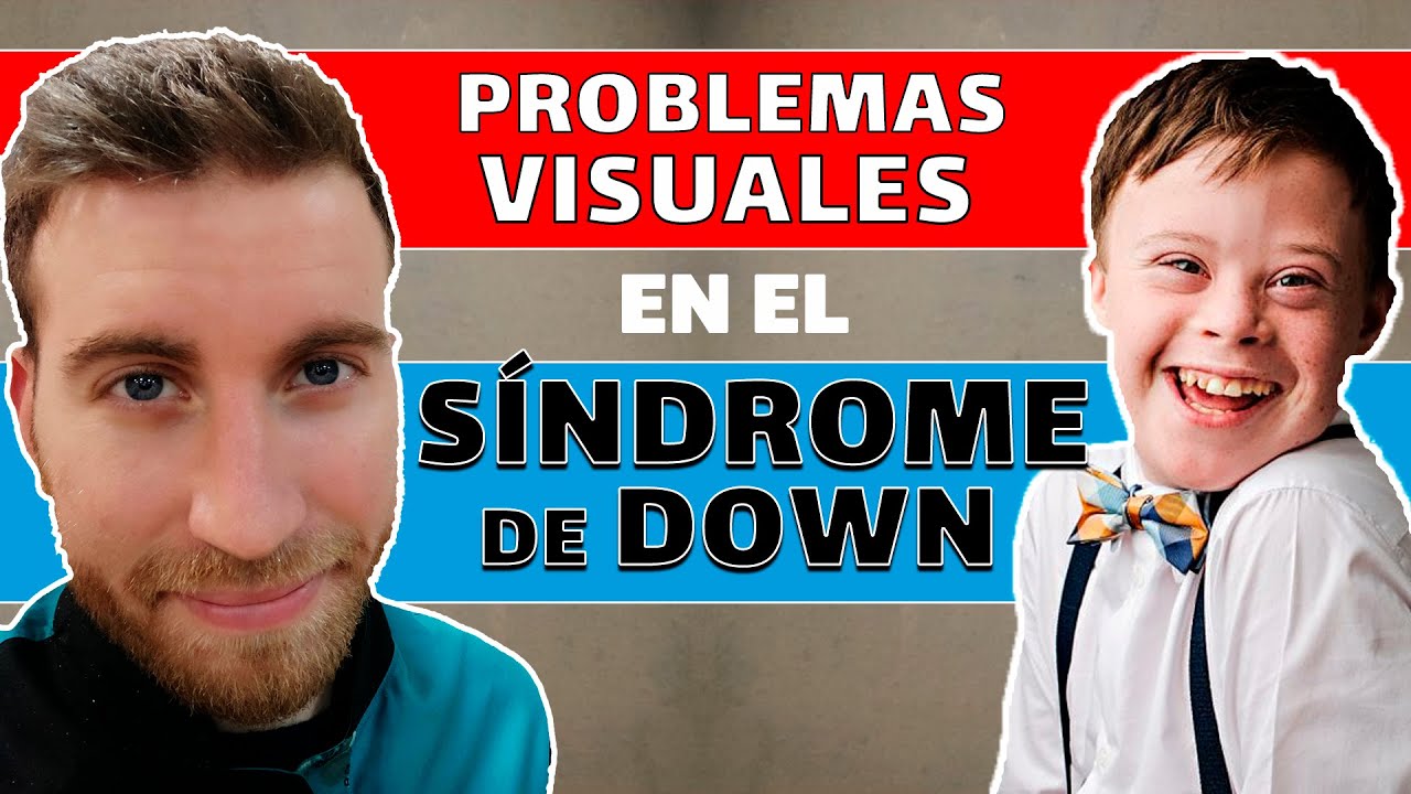 ojos bebes con sindrome de down