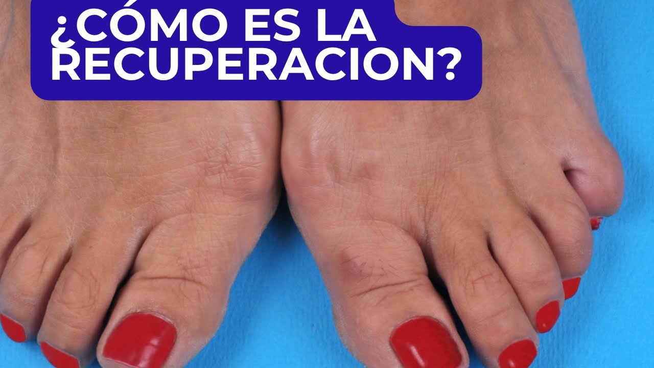 operacion de juanetes y dedo martillo recuperacion