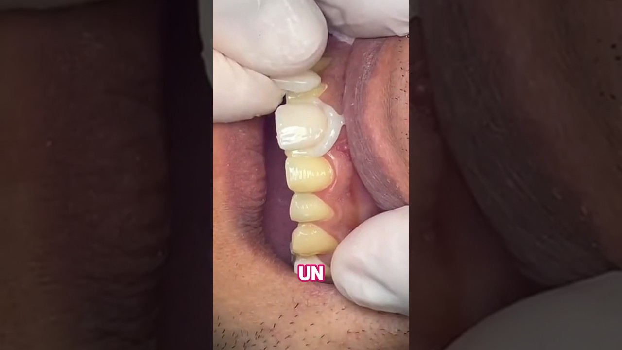 protesis dental de resina o porcelana