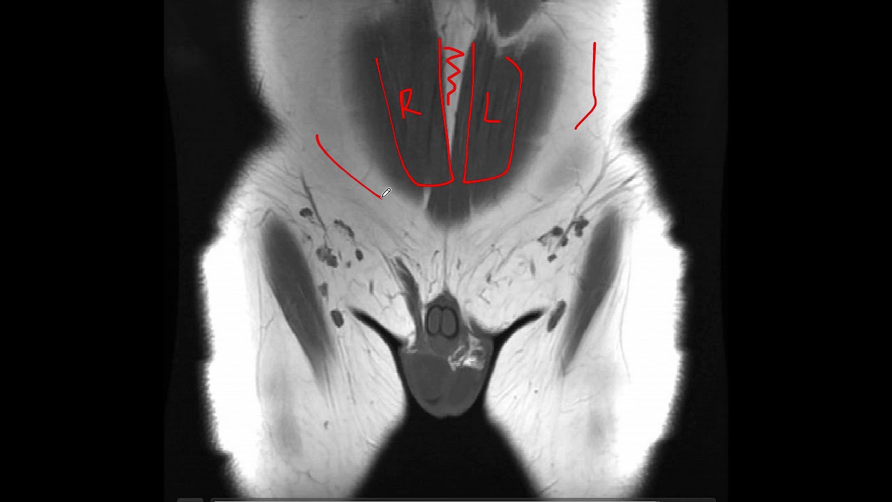 resonancia magnética de cadera y pelvis