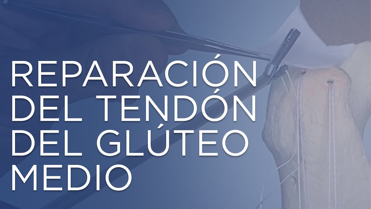 rotura del glúteo medio tiempo de recuperación