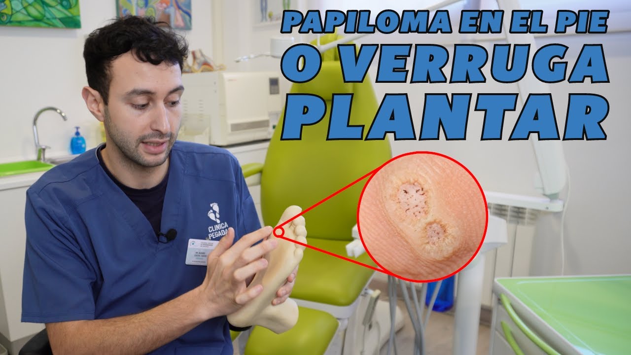 verruga en la planta del pie
