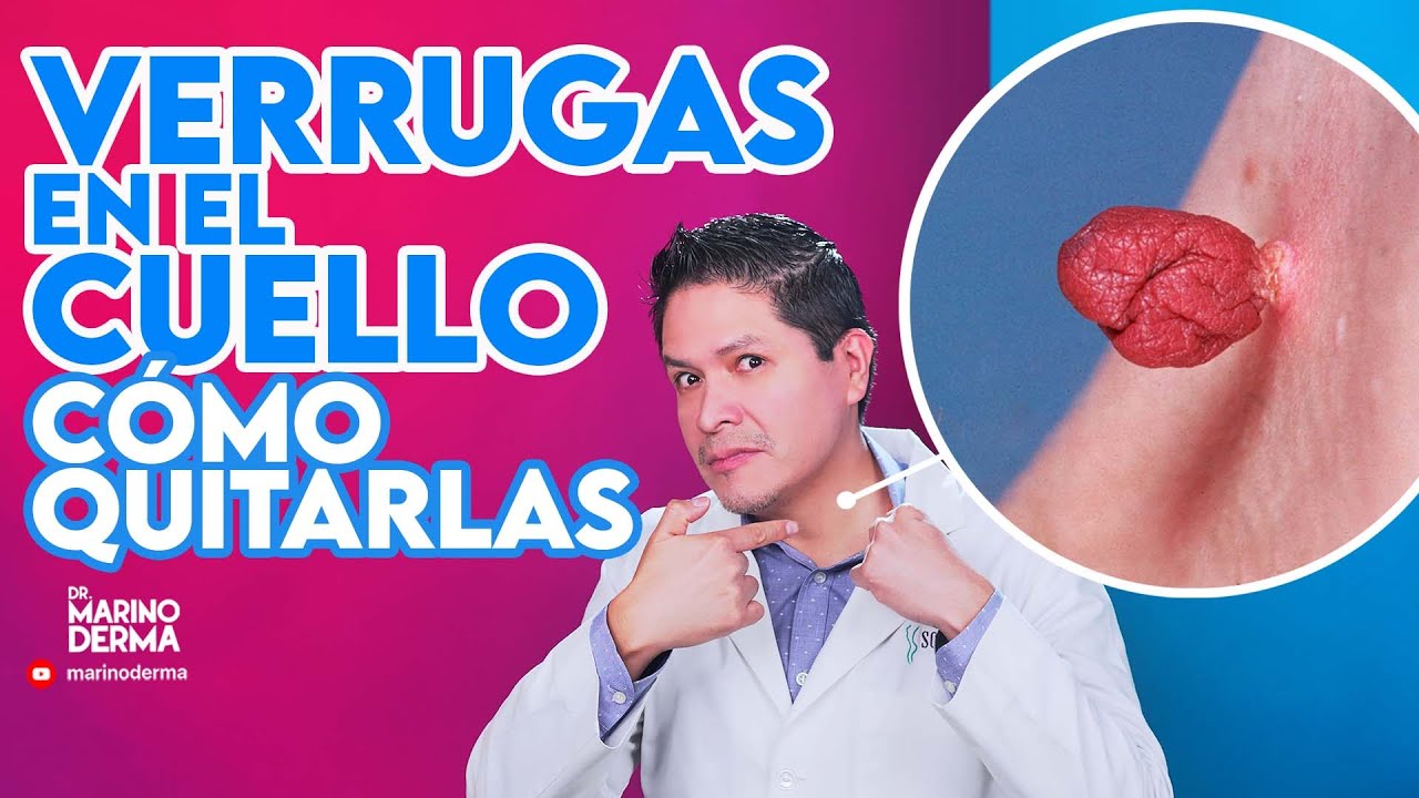 verruga que pica en el cuello