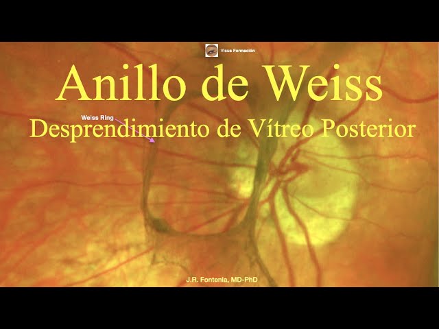 anillo de weiss como se ve
