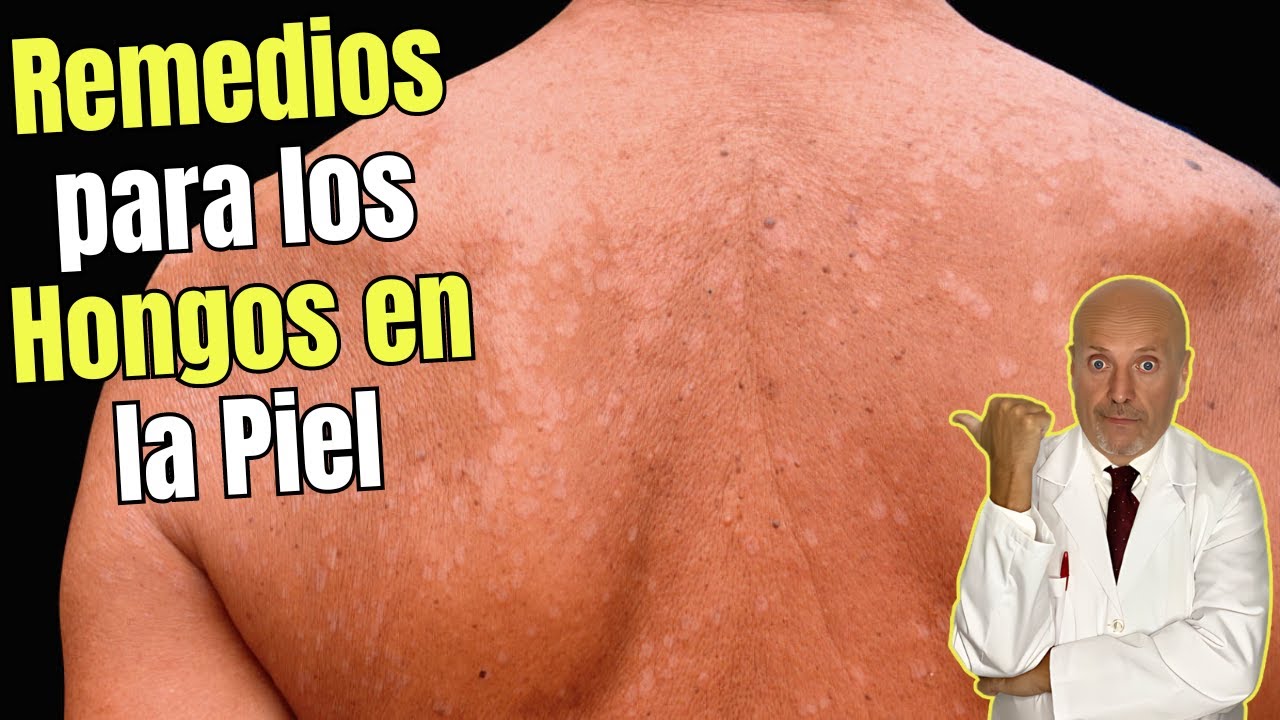 antimicotico para hongos en la piel
