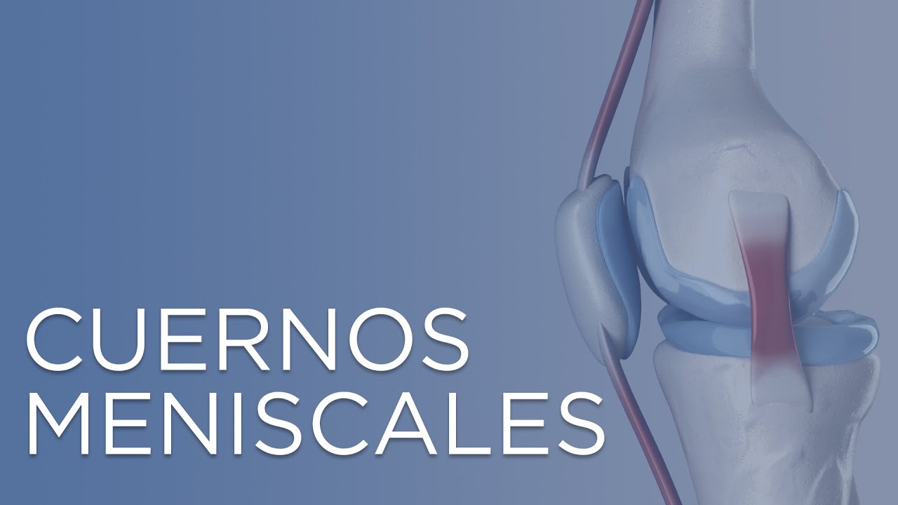 aumento de señal del cuerno posterior del menisco interno