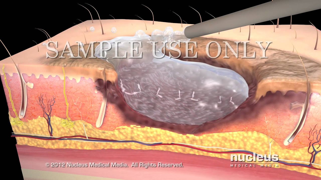 cicatriz injerto de piel antes y despues