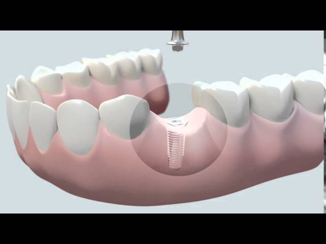 como se coloca la corona en un implante dental