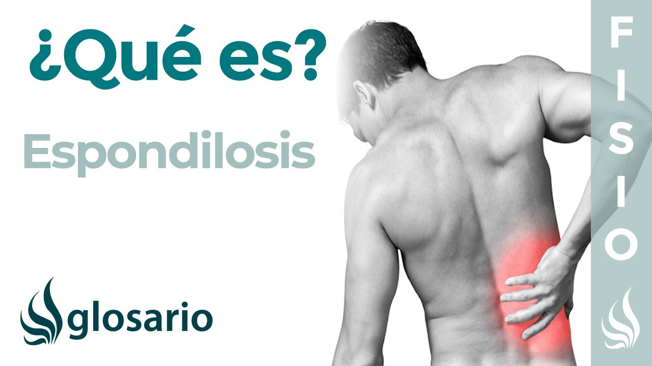 con espondilosis lumbar se puede trabajar
