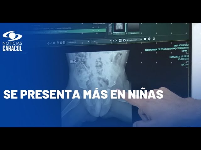 displasia de cadera a los 40 años