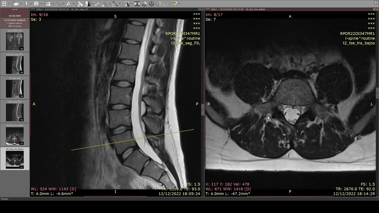 en una resonancia lumbar se ve el sacro
