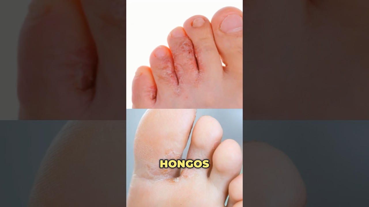 pomada para los hongos de los pies