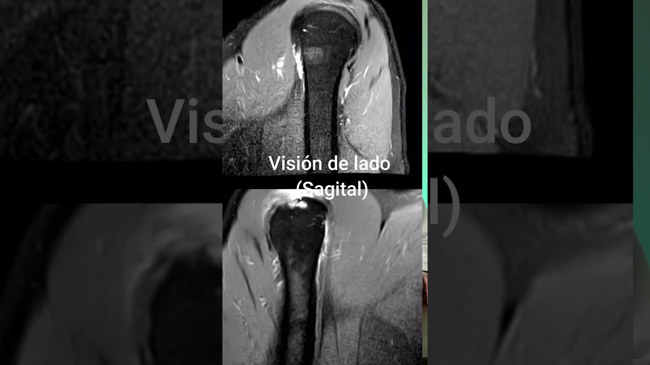 se puede ver una tendinitis con una resonancia