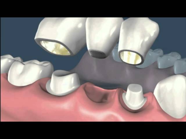 tallado de dientes para puente fijo