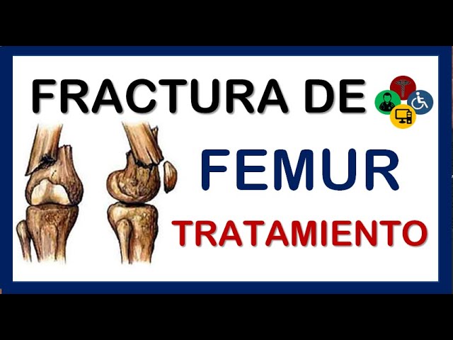 tiempo de recuperación fractura cóndilo femoral
