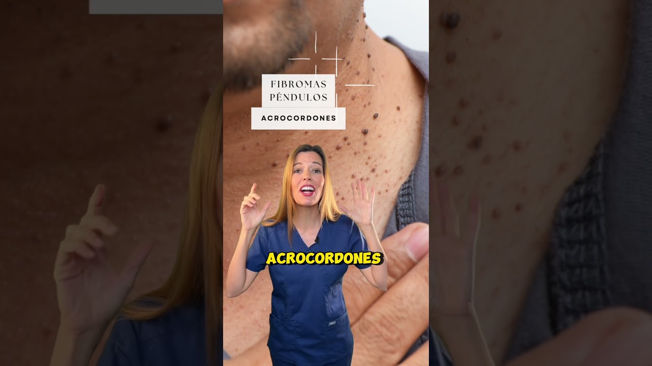 tipos de fibromas en la piel