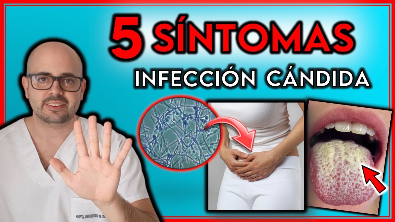 como saber si tengo hongo en la lengua