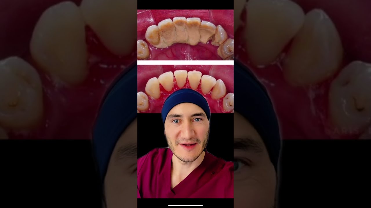 infección después de una limpieza dental