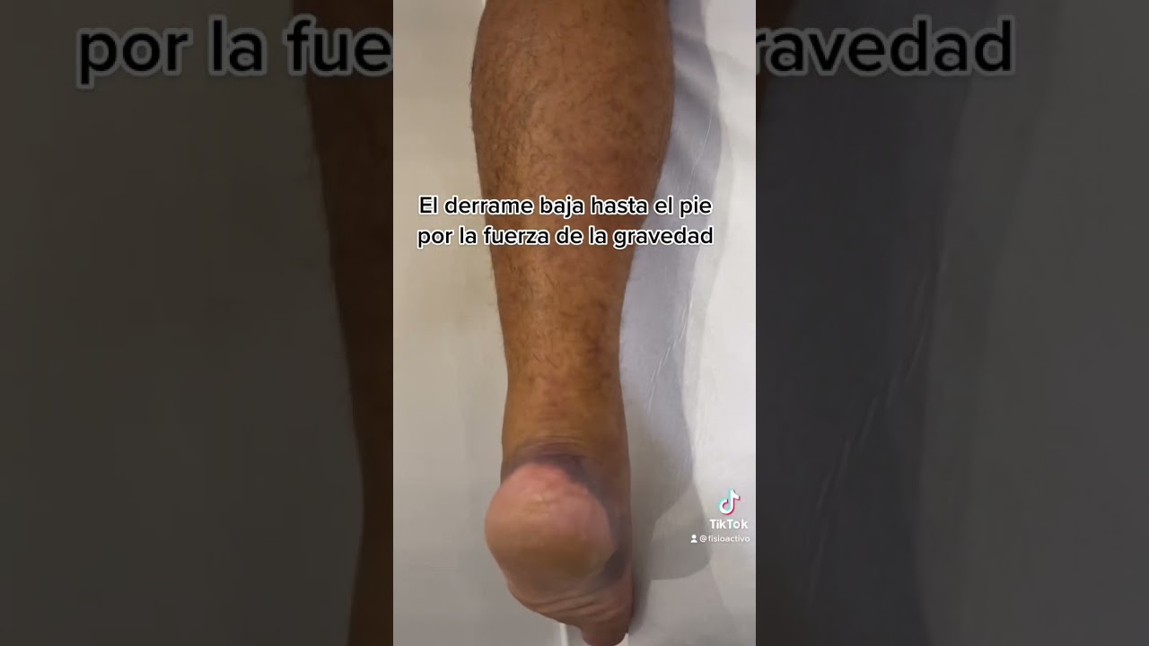 lesion en el soleo tiempo de recuperacion
