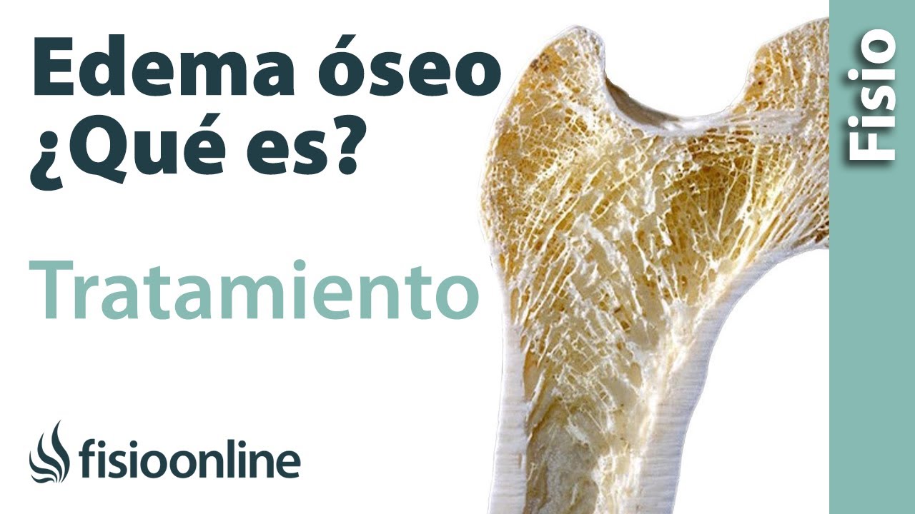 que es un edema oseo en el pie
