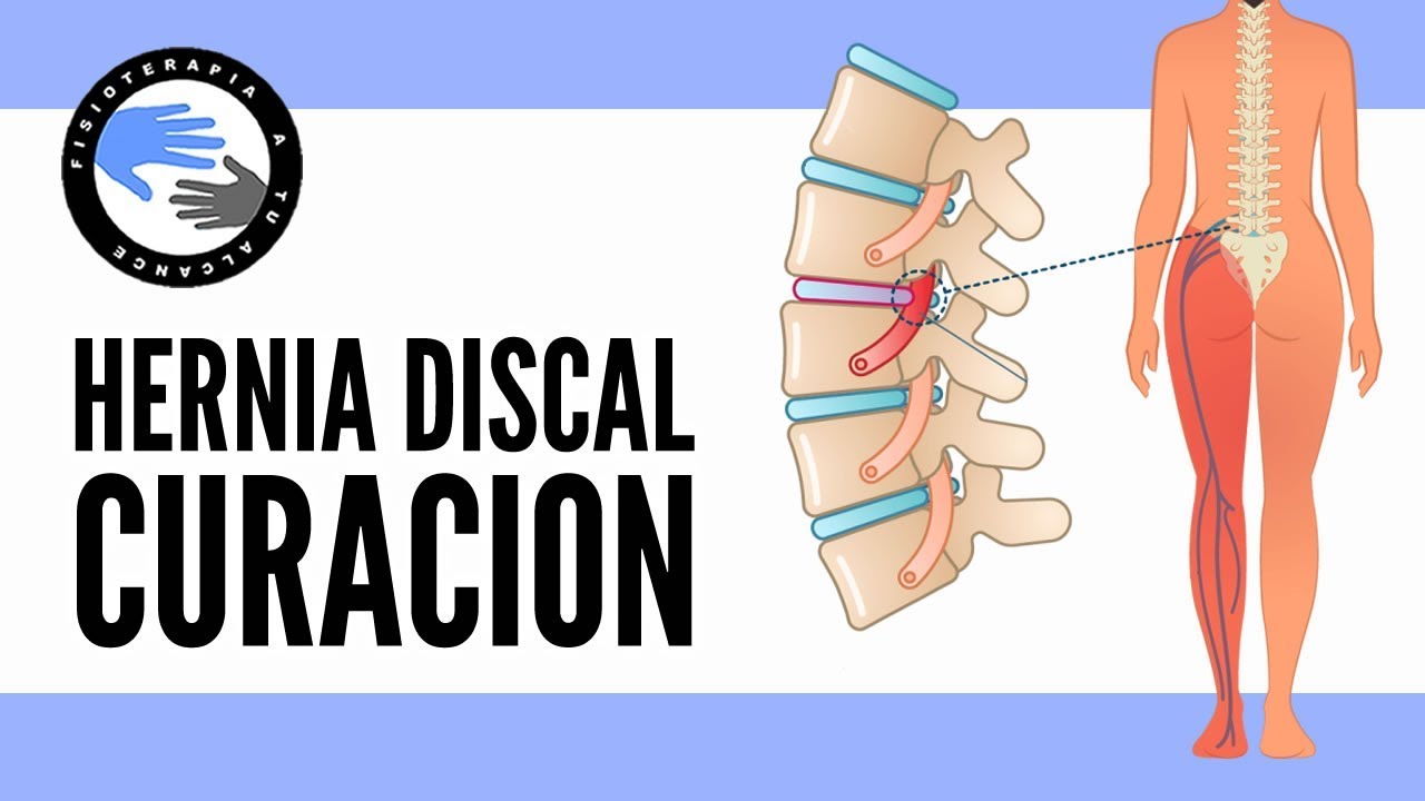 tiempo de baja por protusion discal