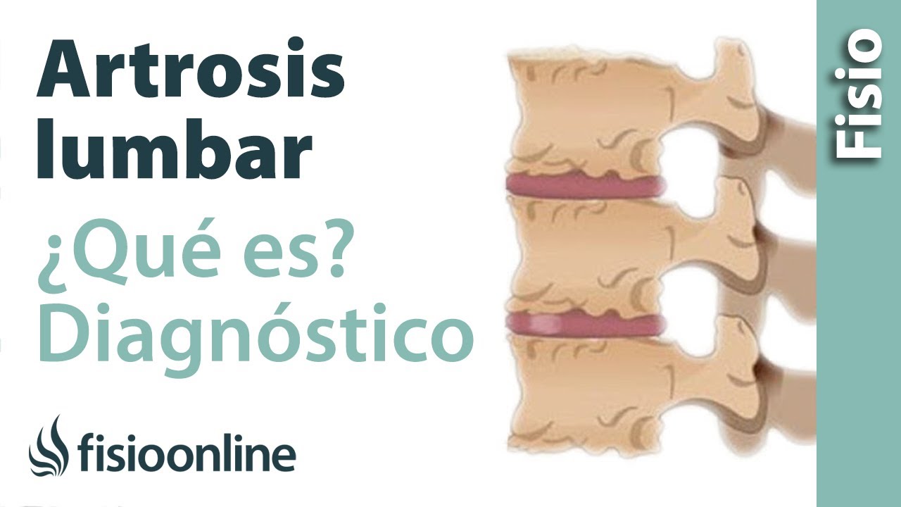 tiempo estimado de baja por artrosis lumbar